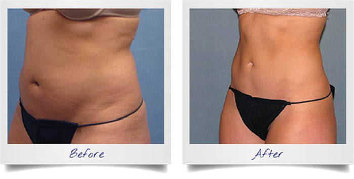 fat freezing before and after photographs 